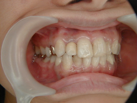 銀歯を白(術前)